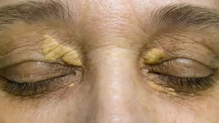 blog-image-xanthelasma-2