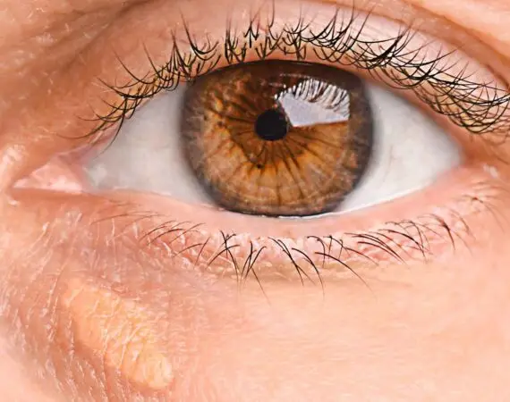 blog-image-xanthelasma-3