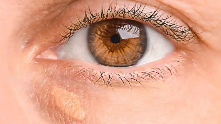 blog-image-xanthelasma-3