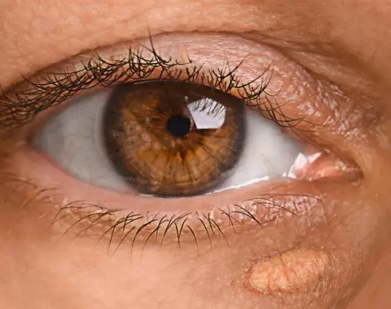 blog-image-xanthelasma-4