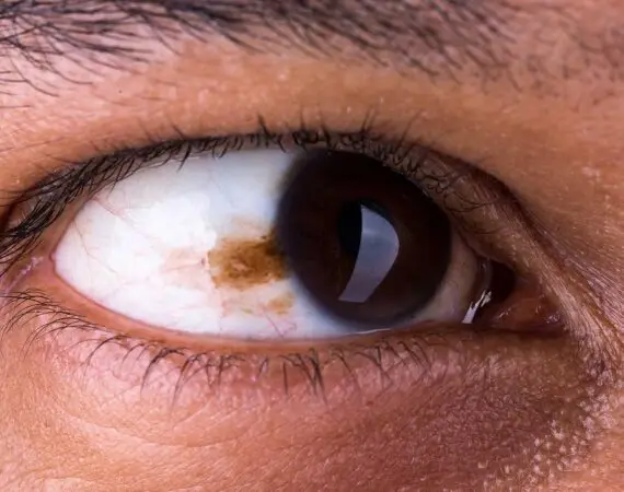 blog-image-conjunctival-naevus-removal-3