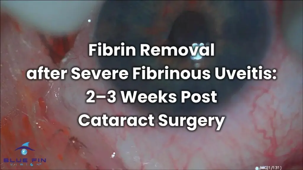 Fibrin Removal 1-Cover