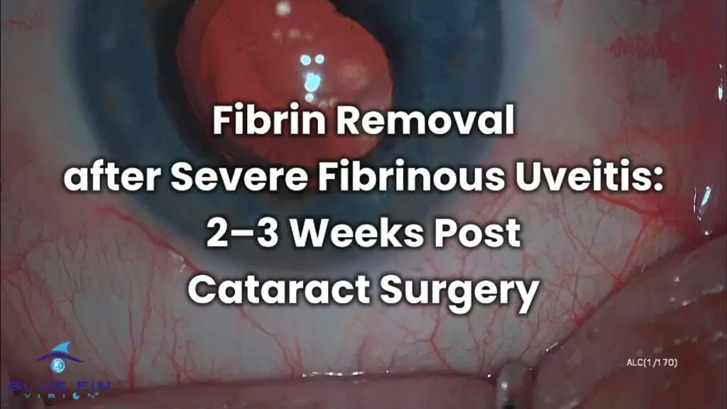 Fibrin Removal 2-Cover
