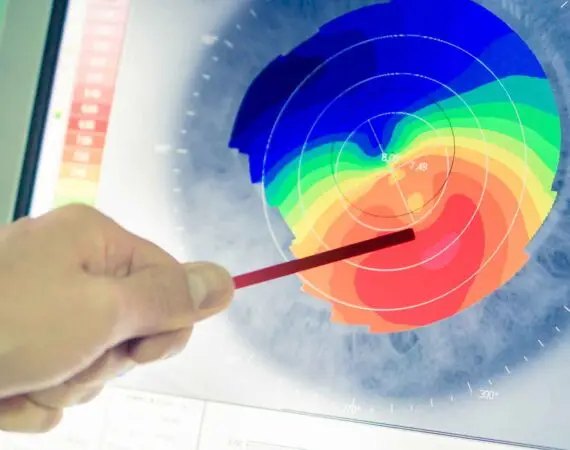blog-image-corneal-topography