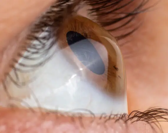blog-image-keratoconus-5