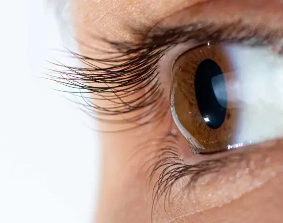 blog-image-keratoconus-6