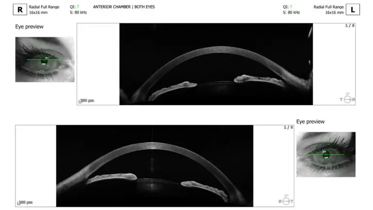 anterior-segment-scan-3