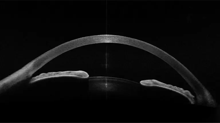 anterior-segment-scan-2