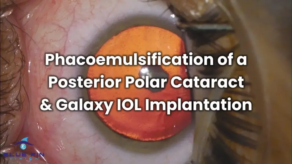 posterior polar cataract phacoemulsification and galaxy lens 2