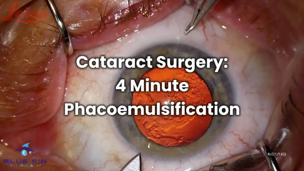 Cataract Surgery 4 Minute Phacoemulsification 1-Cover-New