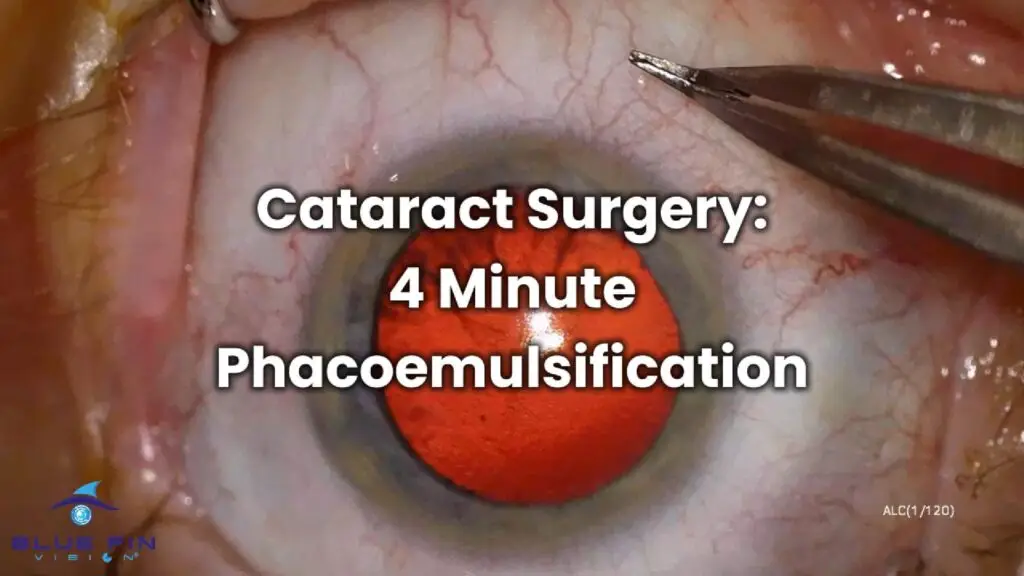 Cataract Surgery 4 Minute Phacoemulsification 2-Cover