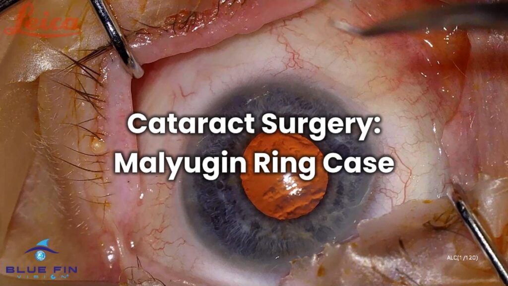 Cataract Surgery Malyugin Ring Case-Cover