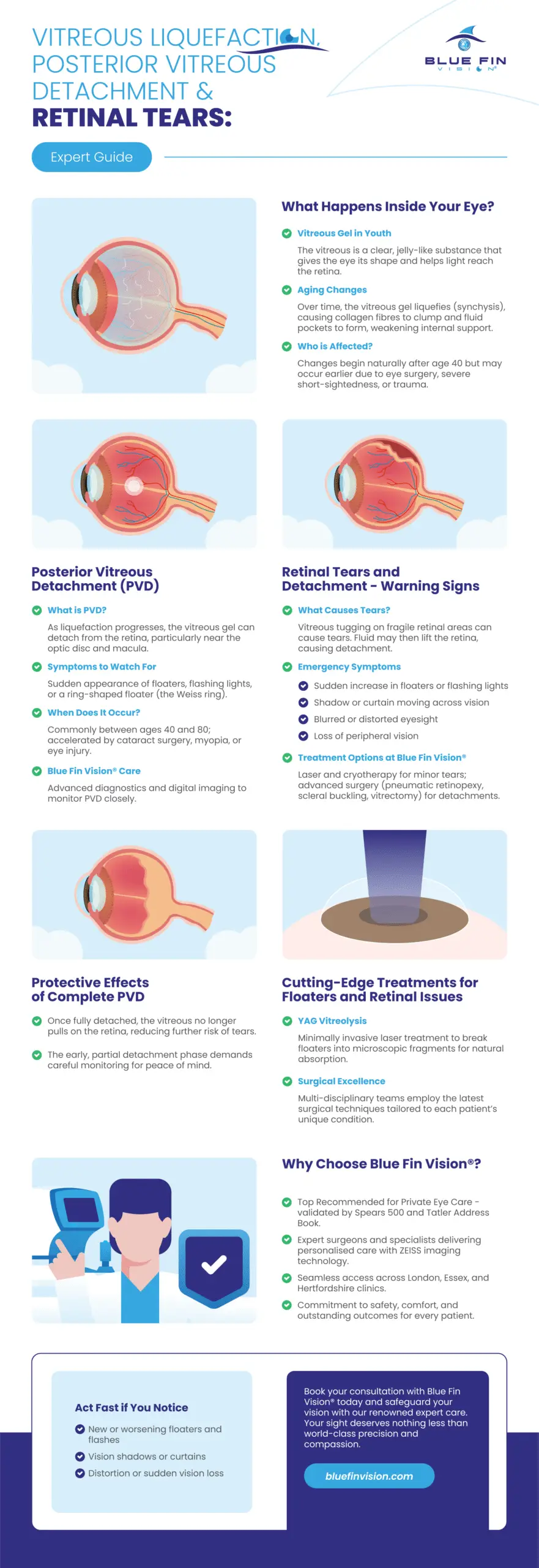 Infographic_693 - Vitreous Liquefaction Posterior Vitreous Detachment and Retinal Tears Expert Guide