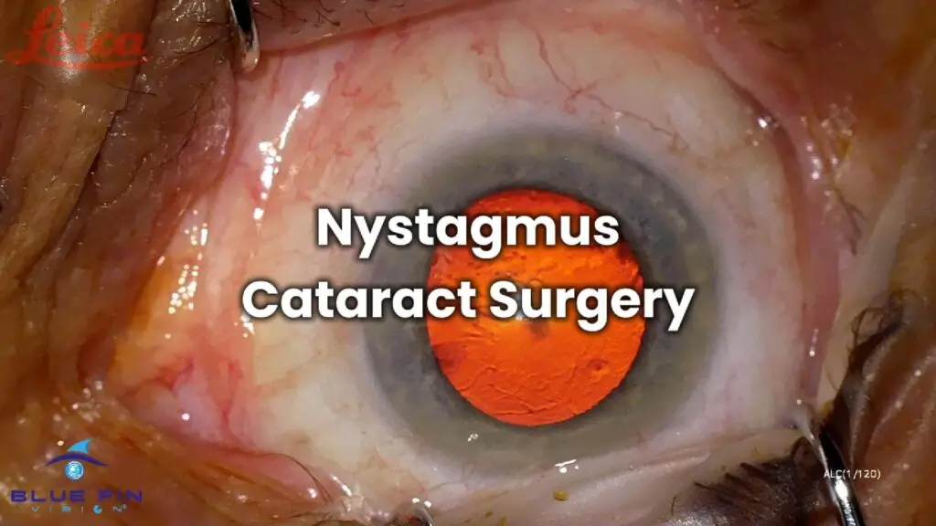Nystagmus Cataract Surgery-Cover