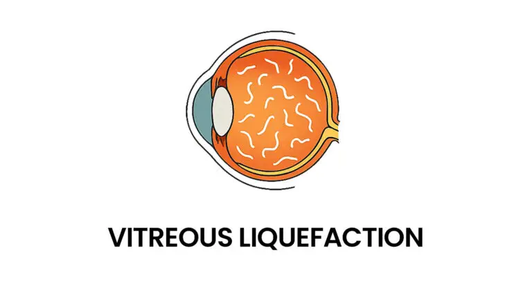 blog-image-vitreous-liquefaction