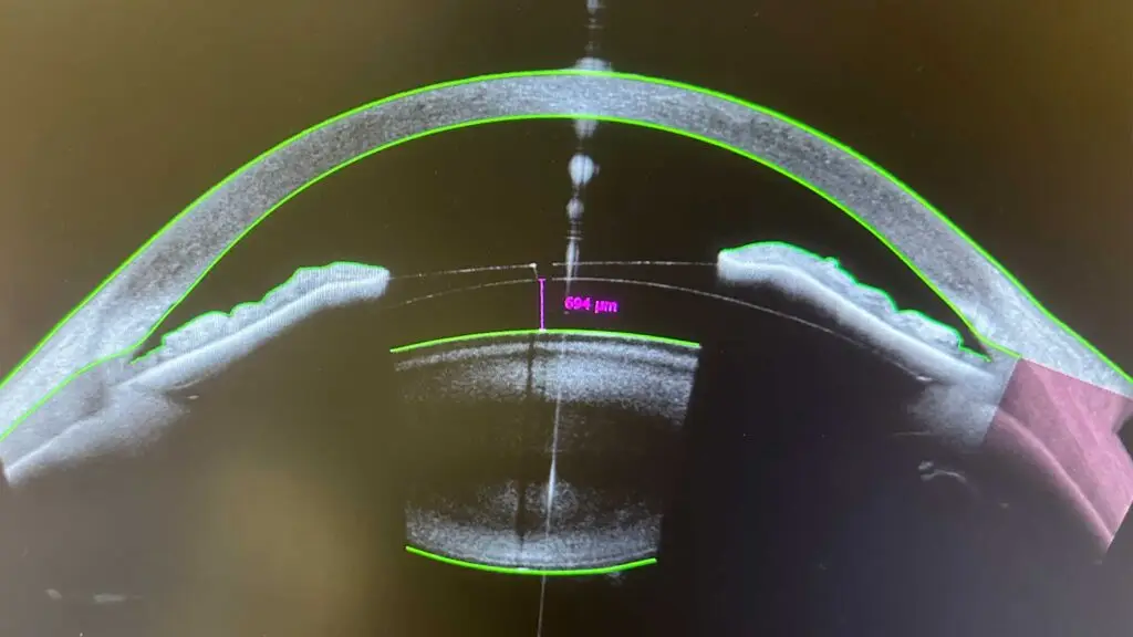 icl-sizing-patient-photo-2