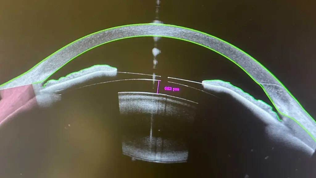 icl-sizing-patient-photo-3