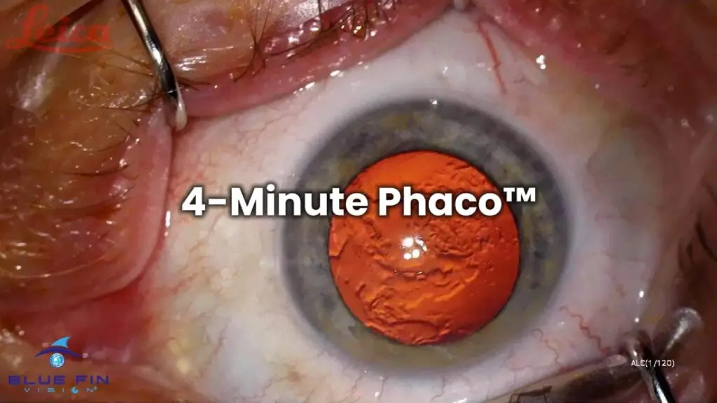 4-Minute Phaco 1-Cover