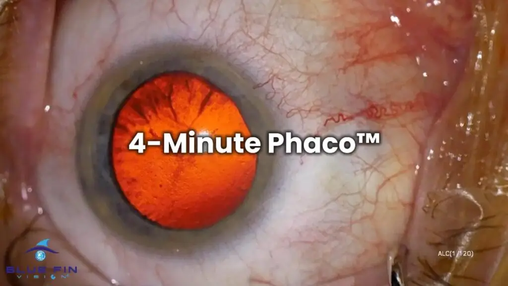 4-Minute Phaco 2-Cover