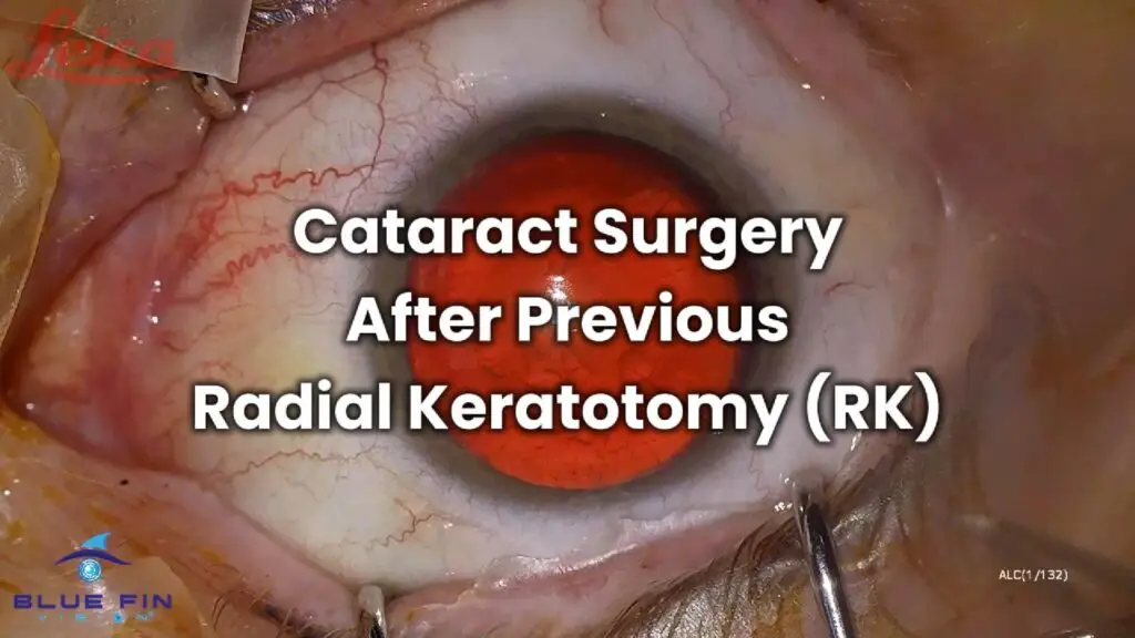 Cataract Surgery After Previous Radial Keratotomy-Cover