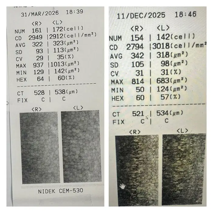 review-icl-surgery-4