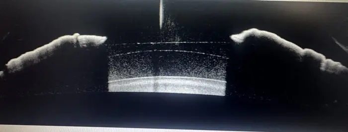 review-icl-surgery-6