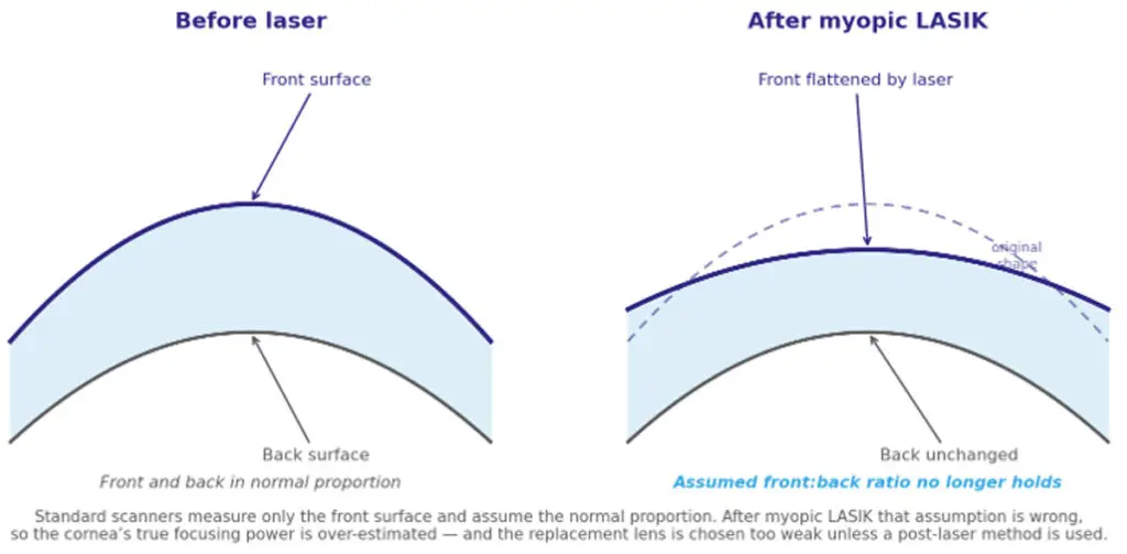 Myopic-LASIK-and-PRK-flatten-the-front-surface-of-the-cornea