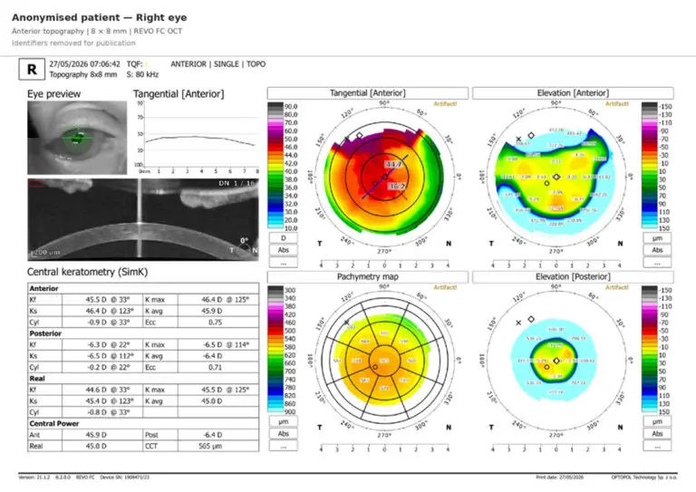 blog-image-double-biometry-for-every-patient-3