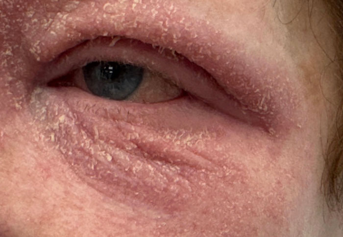 chronic-eyelid-eczema-with-allergic-conjunctivitis-1