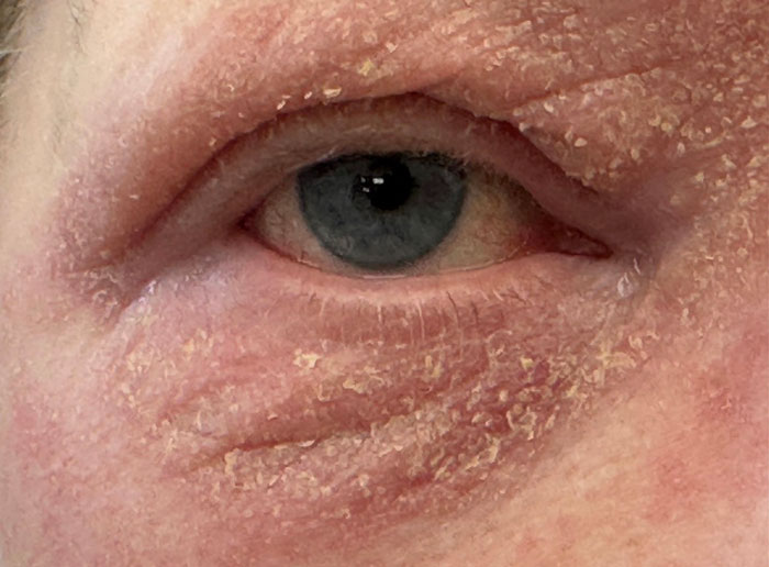 chronic-eyelid-eczema-with-allergic-conjunctivitis-2