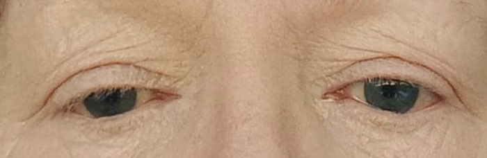 chronic-eyelid-eczema-with-allergic-conjunctivitis-3